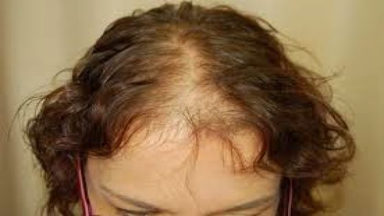 وصفة طبيعية للتخلص من الصلع الأمامي و الشعر الخفيف