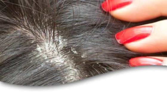 علاج قشرة الشعر بالخل