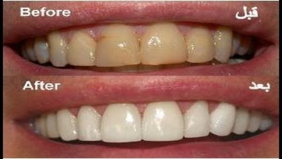 أفضل وأسرع طريقة لتبييض الاسنان وازالة رائحة الفم مضمونة وغير مكلفة وطبيعية