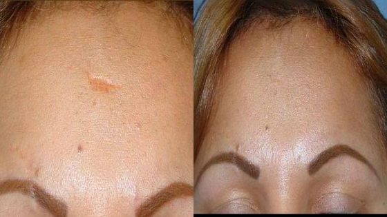 حل خطير و فعال لإزالة السكاتريس