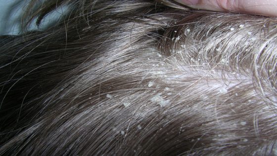 طريقة واعرة تهنيك من قشرة الراس ،من الدهنيات و كتوقف تساقط الشعر