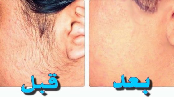 وصفة درات بوززز بين البنات …وصفة تخلص من شعر الوجه ناجحة 100%