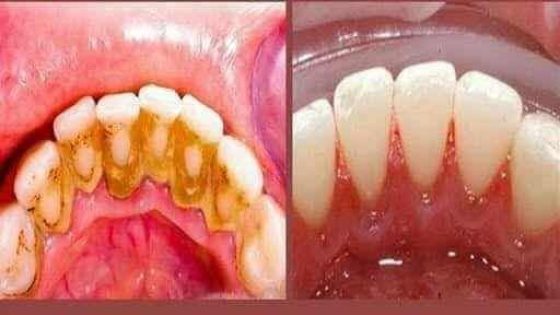وصفة المريمية لتبييض الأسنان و ازالة الجير و حماية الأسنان من التسوس