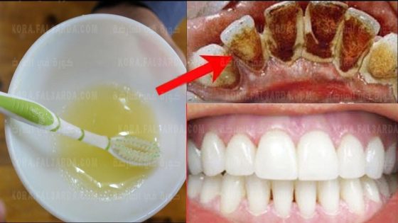 تبييض الاسنان بالمنزل في 2 دقائق || كيف تبيض أسنانك الصفراء بشكل طبيعي