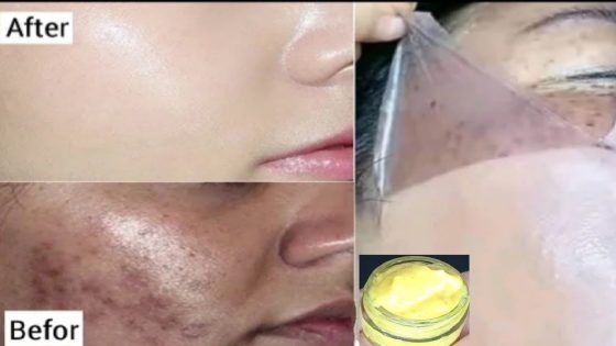 5 ماسكات لعلاج تصبغات الوجه وازالة البقع الداكنة